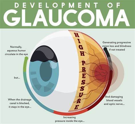 Development of Glaucoma diagram