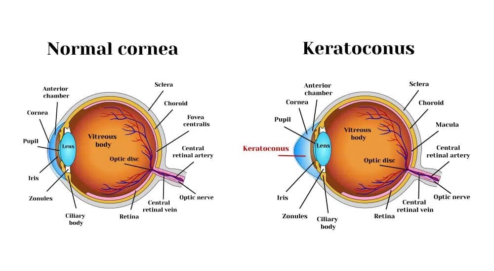 Normal cornea versus keratoconus diagram