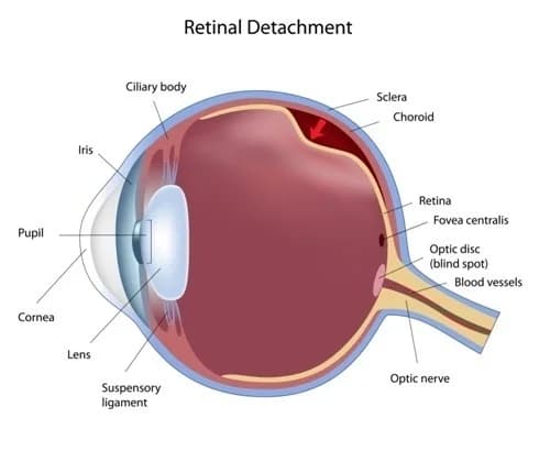 Gambar rajah Penanggalan Retina