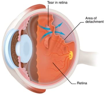 Gambar rajah koyakan retina dan kawasan penanggalan