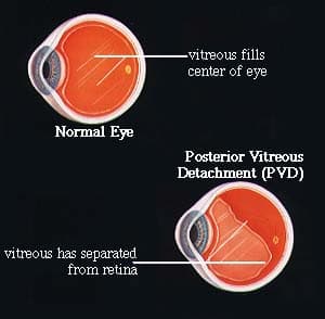 Gambar rajah Mata Normal berbanding Penanggalan Vitreus Posterior (PVD)